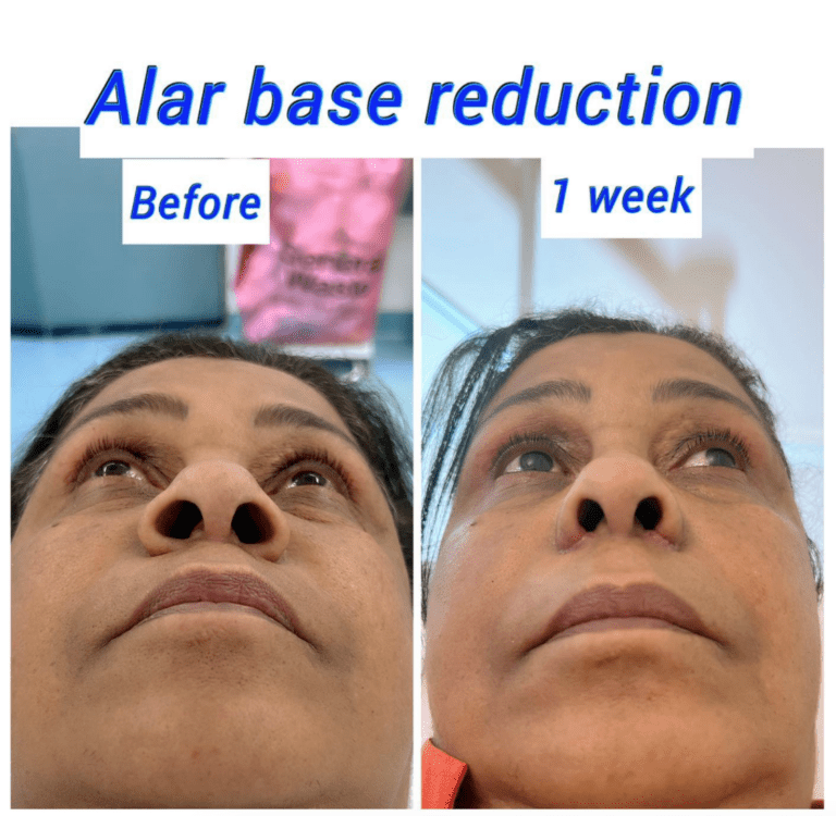 Before and after alar base reduction, nostril reduction at the Harley Clinic