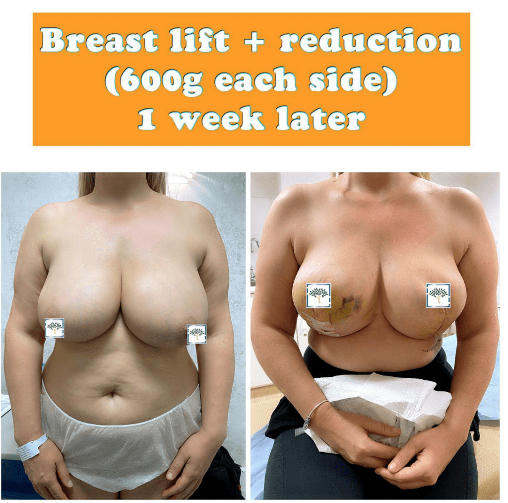 Breast lift and reduction 1 week later - the Harley Clinic