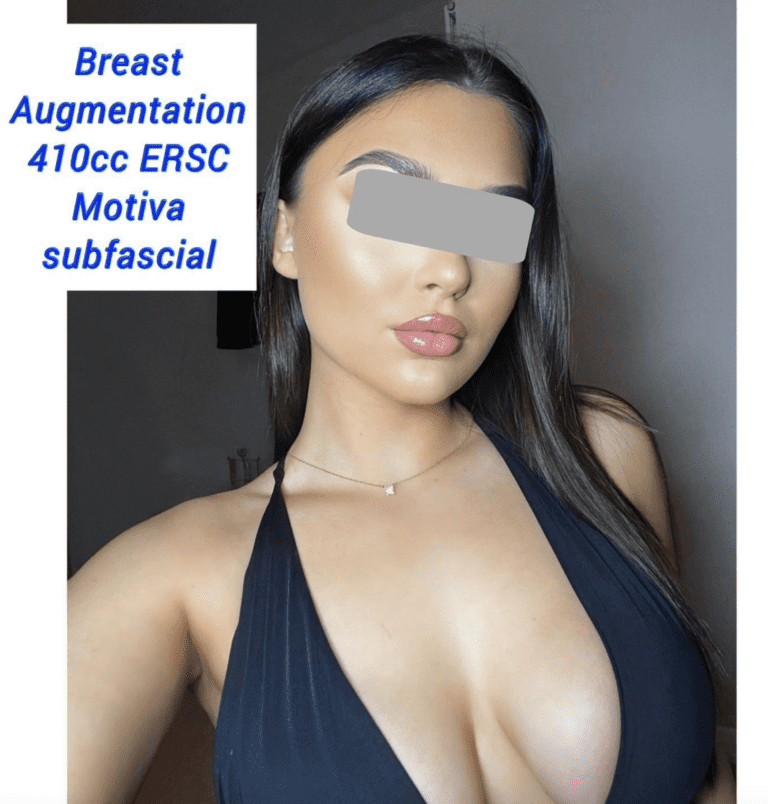 Breast augmentation 410cc ERSC Motiva subfascial