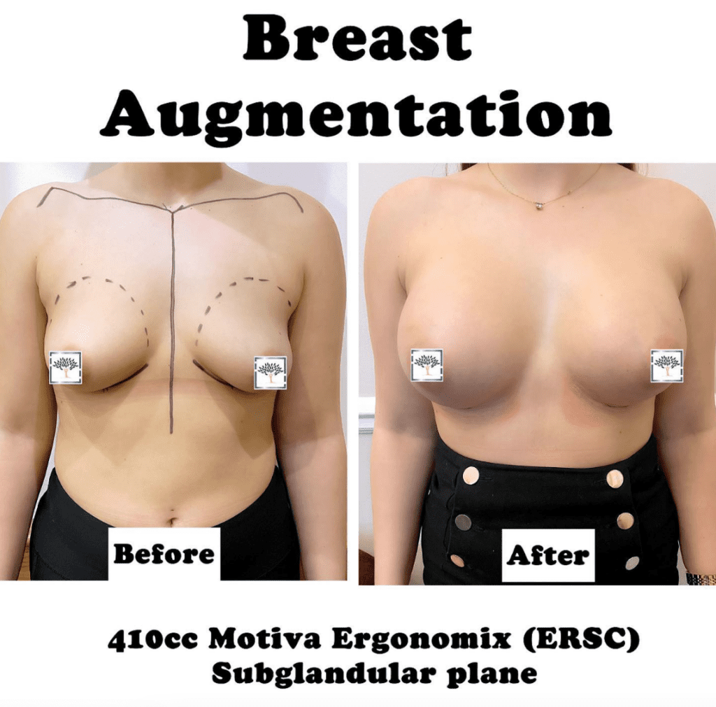 Breast augmentation before and after - 410cc Motiva Ergonomix