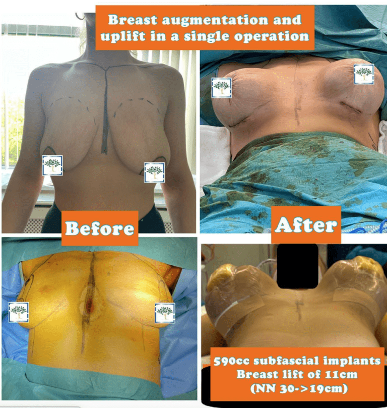 Breast augmentation and uplift - 690cc subfasical implants