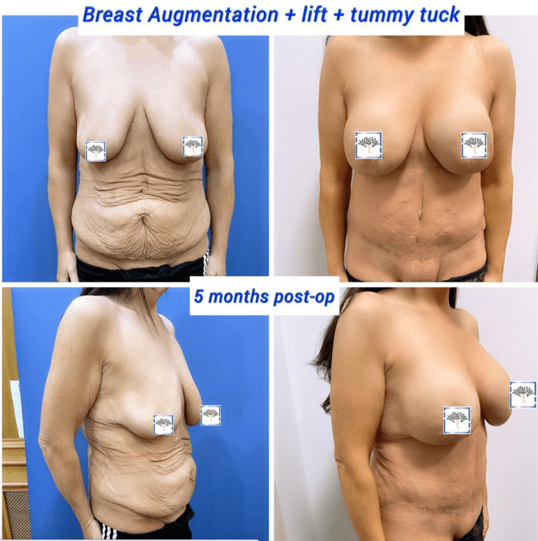 Breast augmentation, lift, and tummy tuck - the Harley Clinic