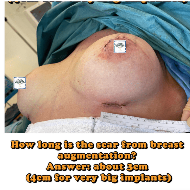 Breast augmentation scar