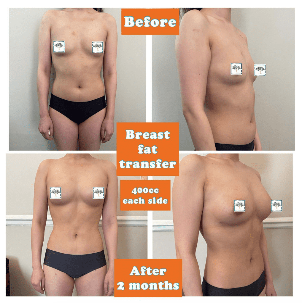 Antes y después de la transferencia de grasa mamaria - 400 cc por cada lado