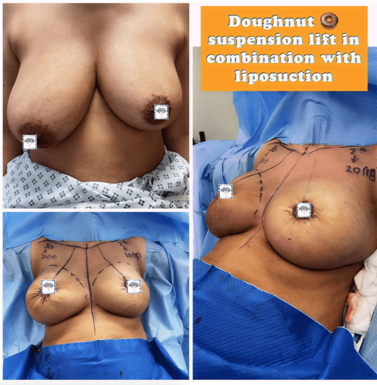 Doughnut suspension lift in combination with liposuction