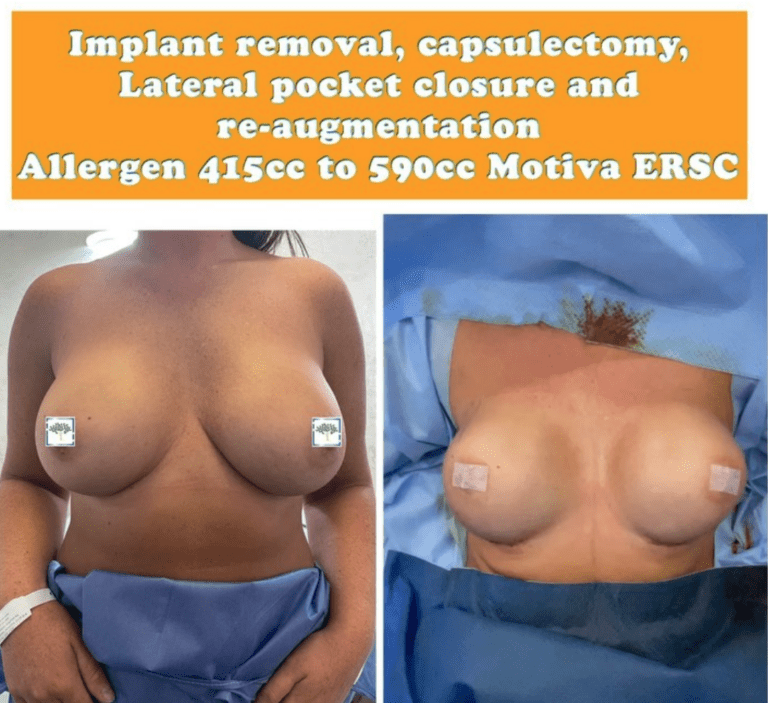 Implant removal, capsulectomy, breast re-augmentation - the Harley Clinic