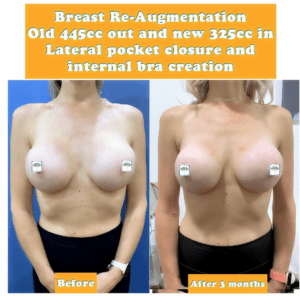 Breast re-augmentation replaced with 325cc in lateral pocket closure and internal bra creation