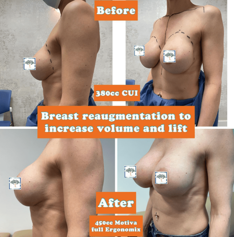 Before and after breast re-augmentation