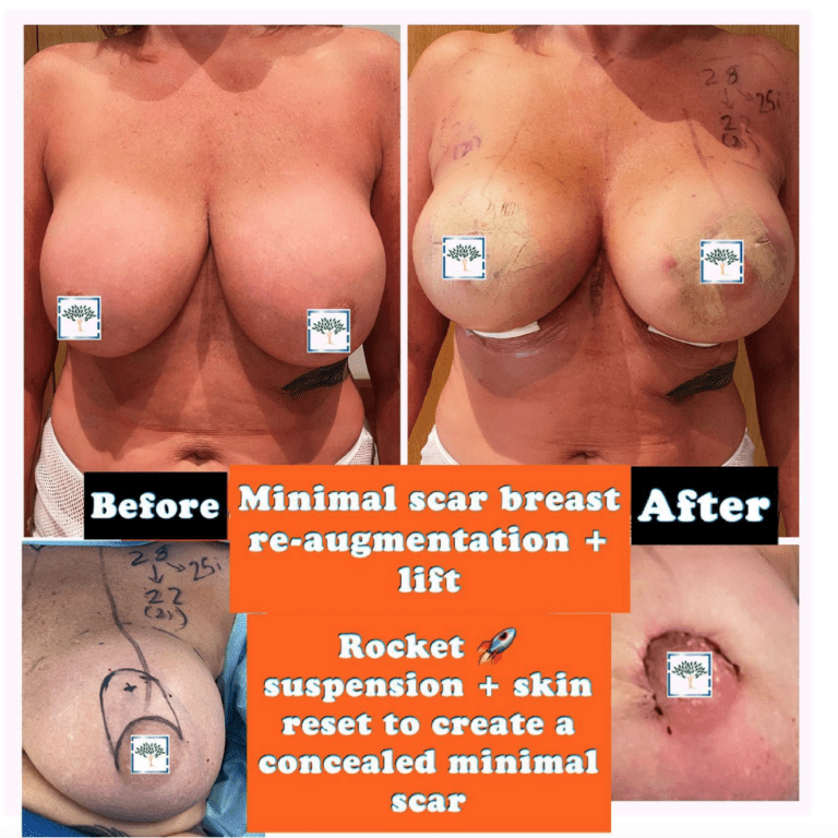 Breast re-augmentation and uplift - the Harley Clinic