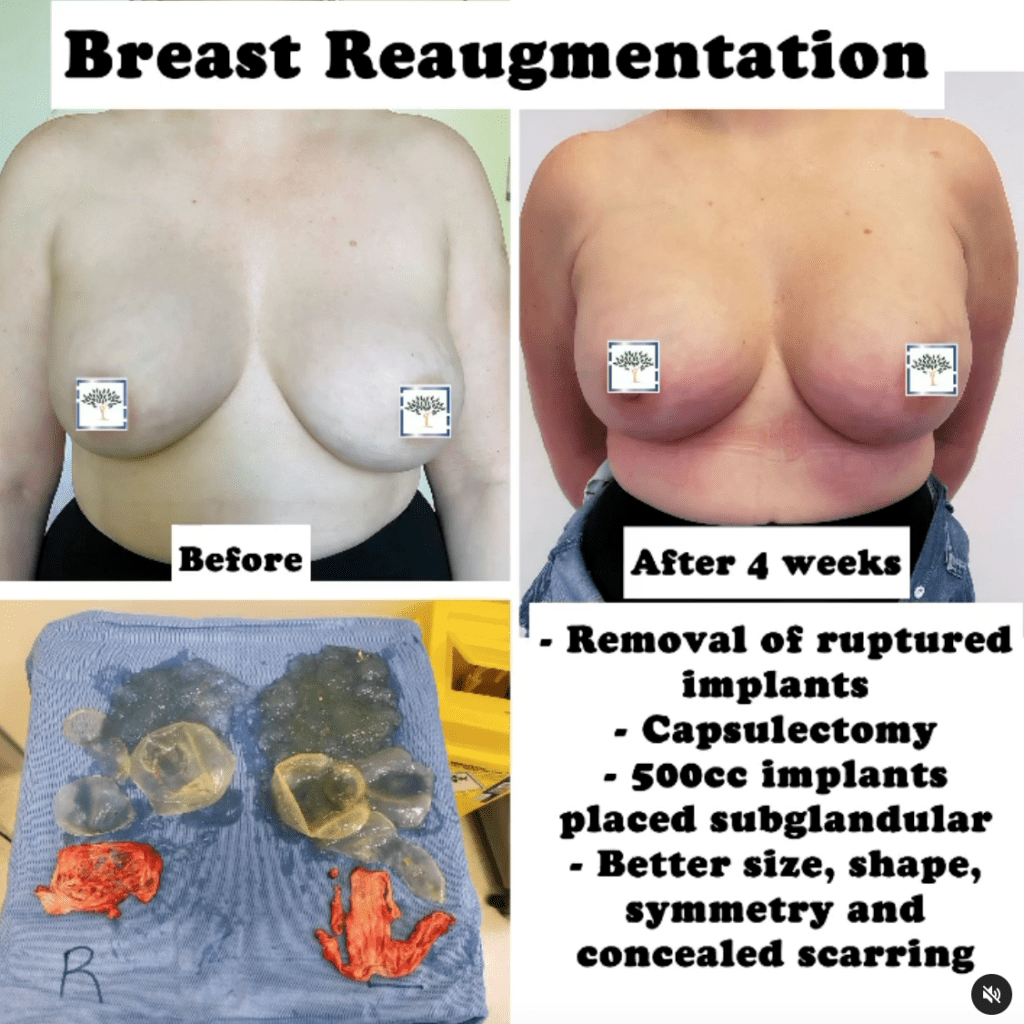 Re-aumento de senos y remoción de ruptura de un implante de seno