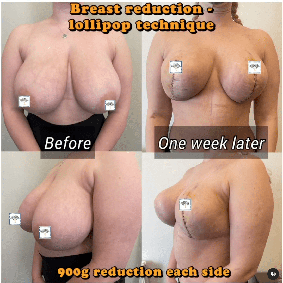 Before and after breast reduction - lollipop technique - the Harley Clinic