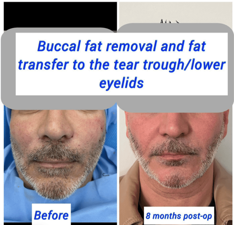 Before and after buccal fat removal and fat transfer to the tear trough/lower eyelids at the Harley Clinic