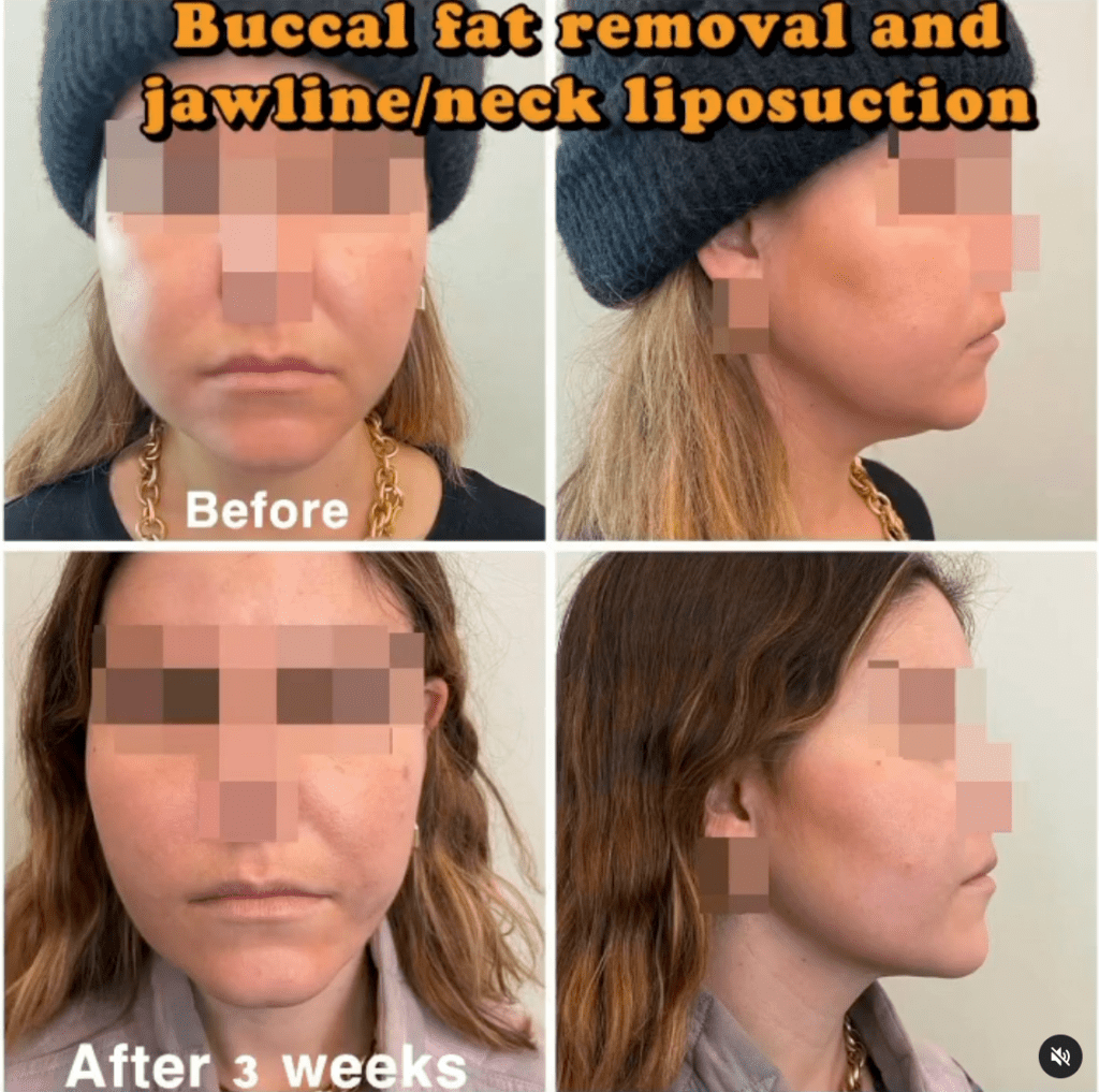 Buccal fat removal and jawline/neck liposuction