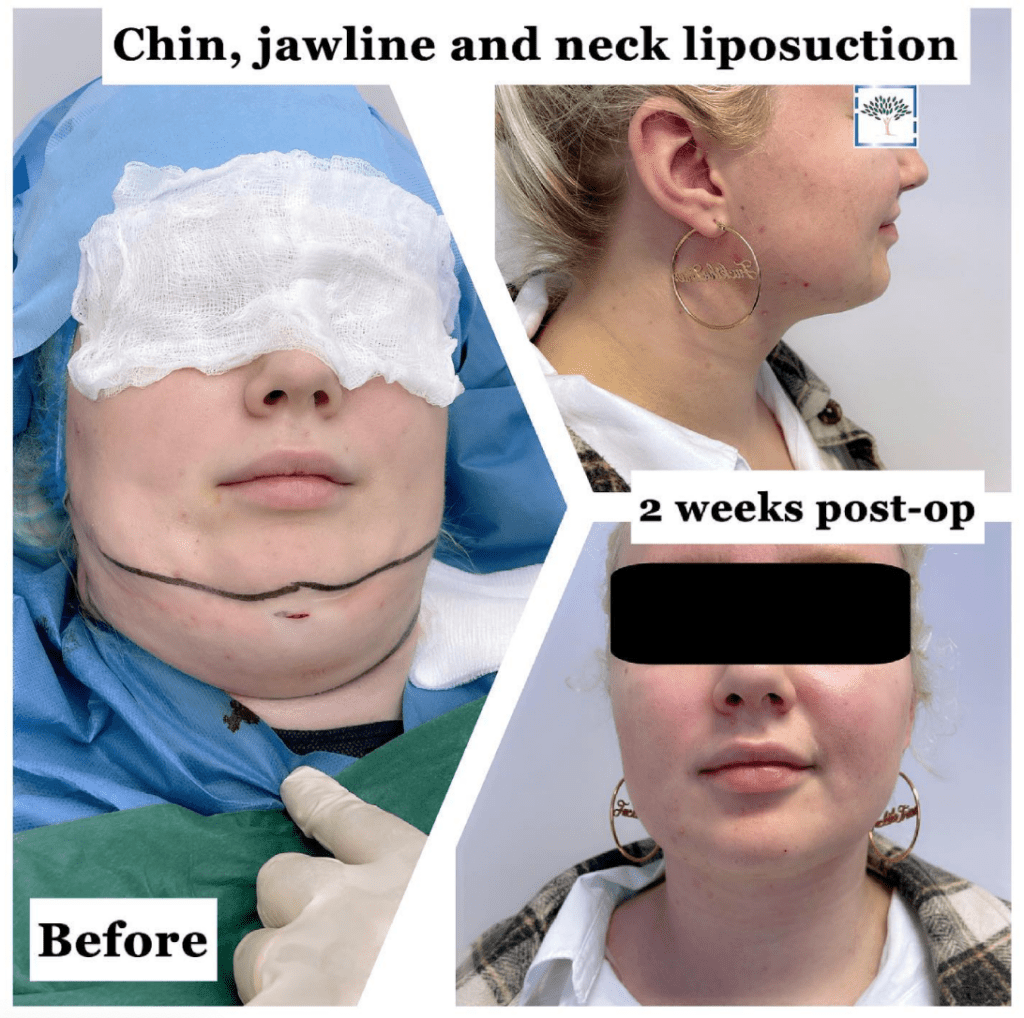 Chin, jawline, and neck liposuction before and after, the Harley Clinic London