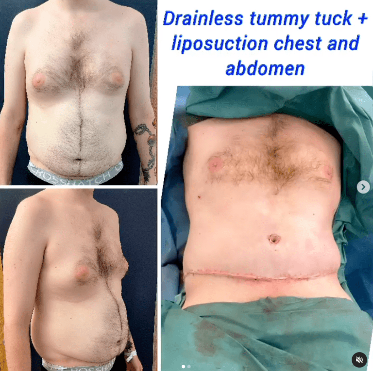 Drainless male tummy tuck and chest and abdomen liposuction