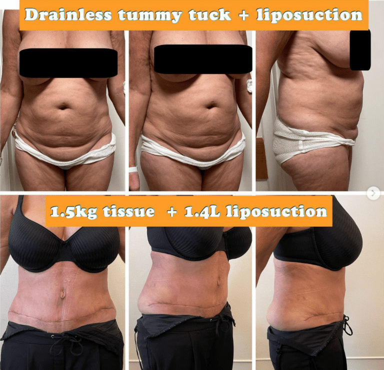 Drainless tummy tuck and liposuction