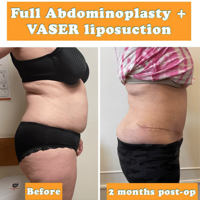 Full tummy tuck and Vaser liposuction