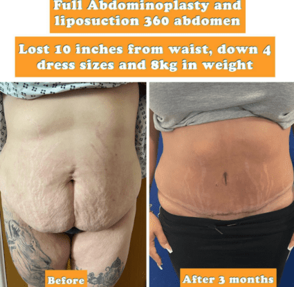 melanotic whitlow causes 5 Weeks Post Liposuction and C-Section Revision Update main image 0