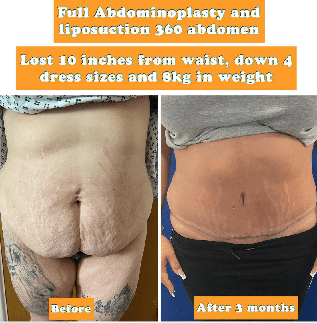 can you get lipo after c section C-Section Shelf