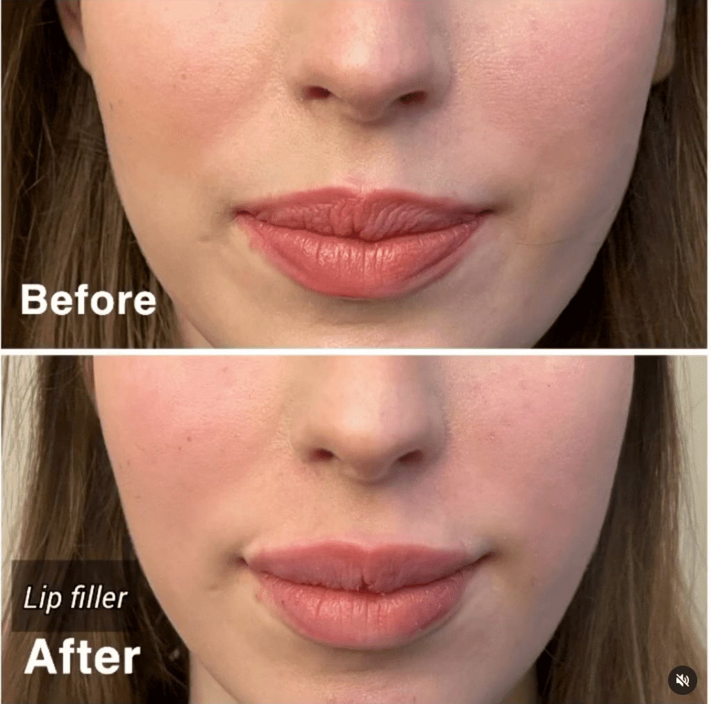 Lip Filler Injections How Long do They Last? Harley Clinic