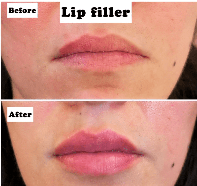 Before and after lip filler injections at the Harley Clinic
