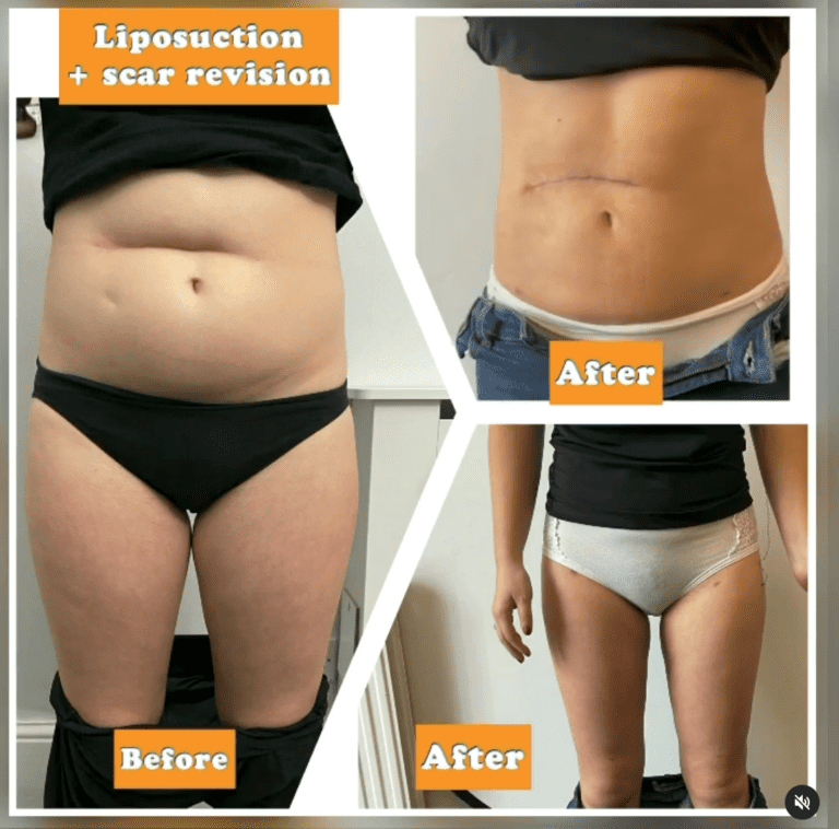 Before and after liposuction and scar revision, the Harley Clinic