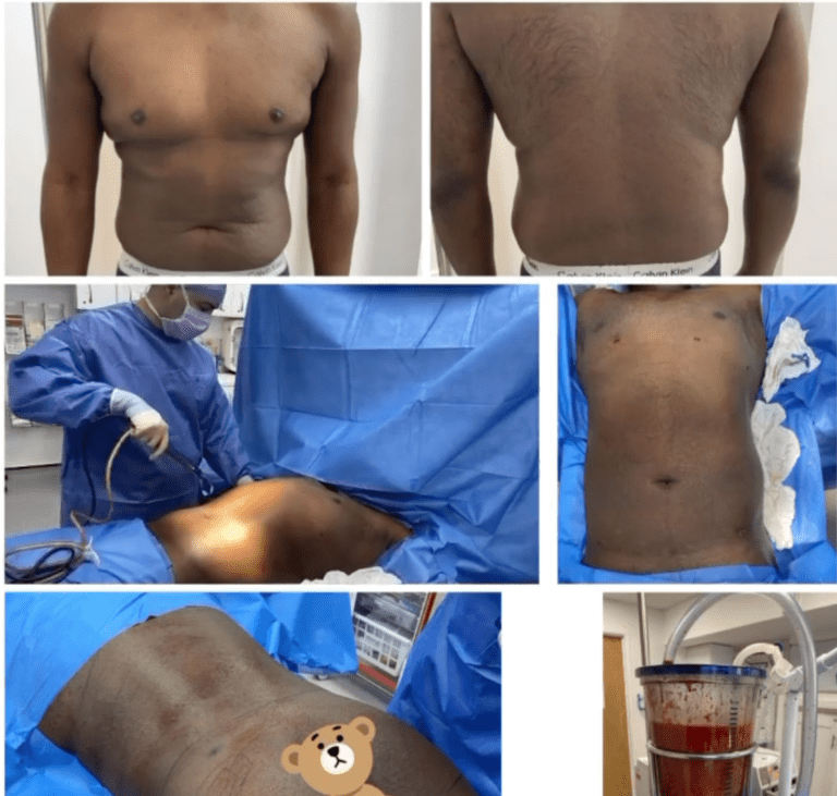 Male breast reduction surgery at The Harley Clinic, London