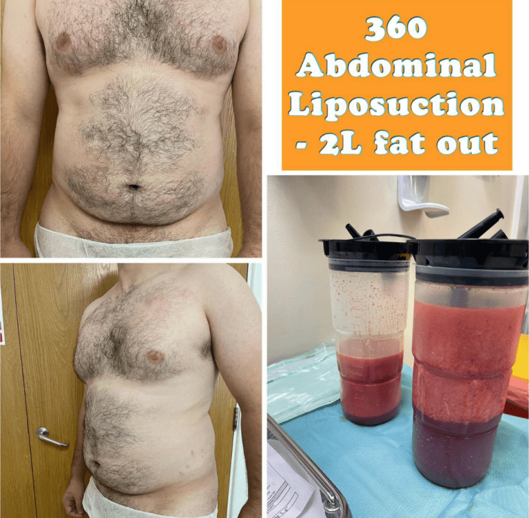 360 Male abdominal liposuction at the Harley Clinic