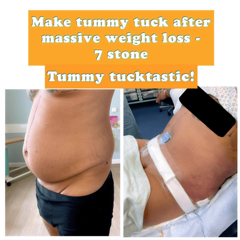 Male tummy tuck after massive weight loss at the Harley Clinic
