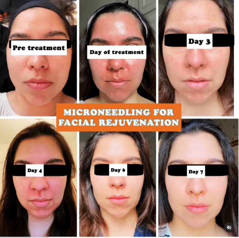 Microneedling for facial rejuvenation, the Harley Clinic
