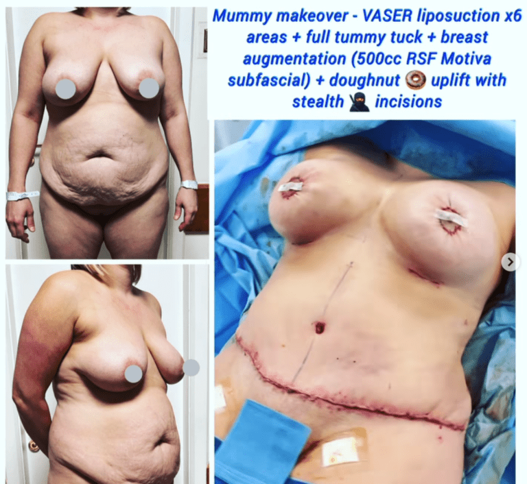 Mummy makeover at the Harley Clinic (Vaser liposuction in 6 areas, full tummy tuck, breast augmentation and doughnut uplift at the Harley Clinic