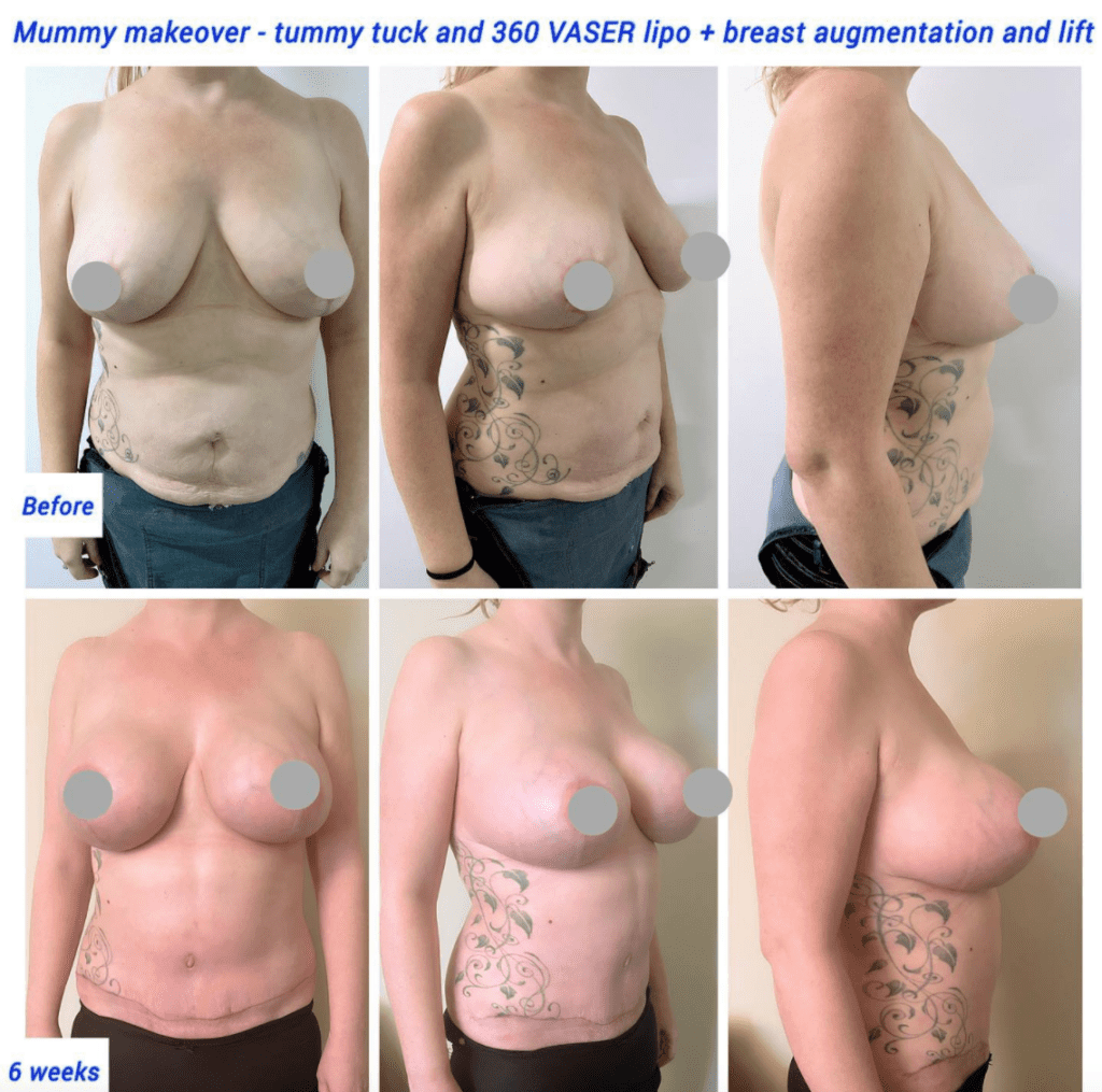 Mummy makeover at the Harley Clinic (VASER lipo, tummy tuck, breast augmentation, breast lift)