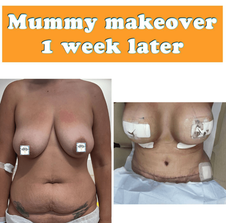 1 week after mummy makeover - the Harley Clinic