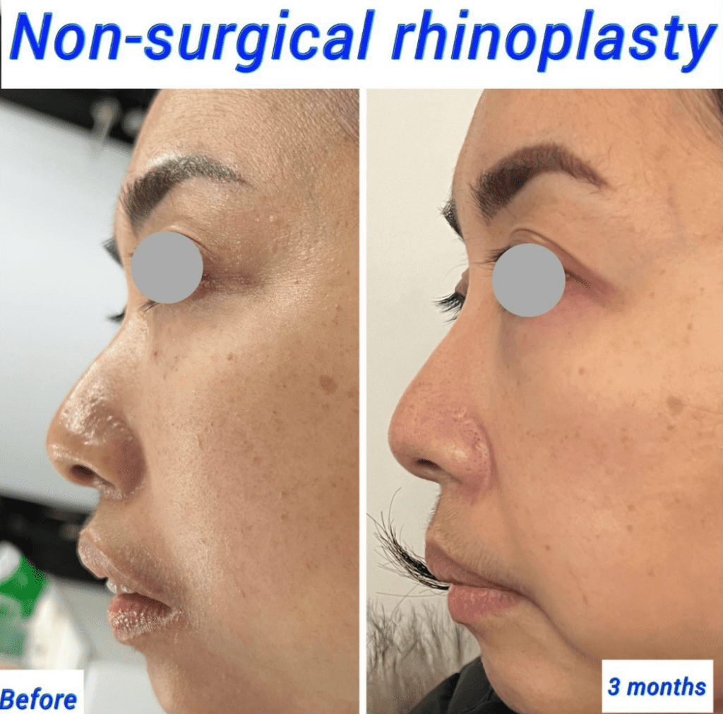 recuperación de rinoplastia no quirúrgica - antes y después - en Harley Clinic