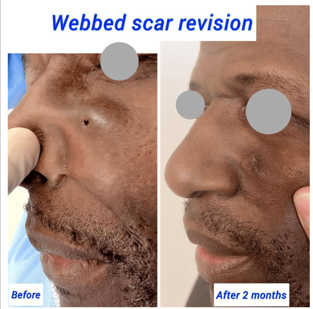 Before and after webbed scar revision at the Harley Clinic