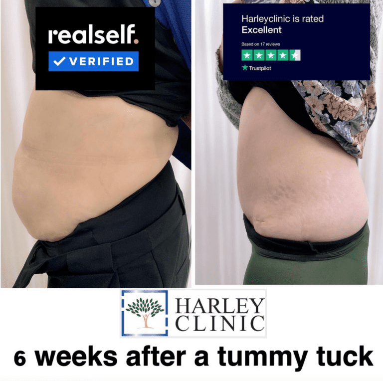 Tummy tuck 6 weeks after operation at The Harley Clinic