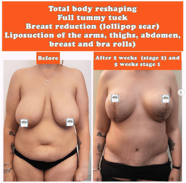 Full tummy tuck, breast reduction, and liposuction, the Harley Clinic