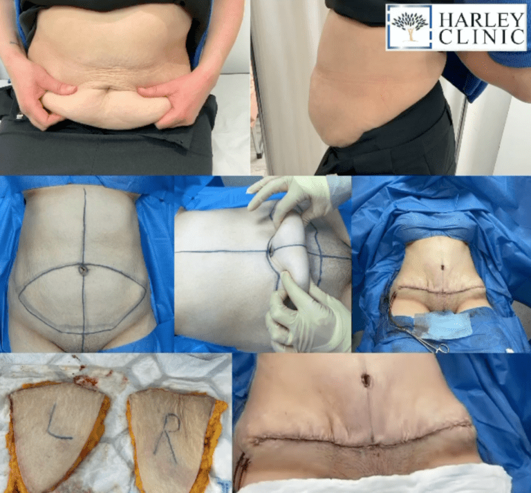 Before and after tummy tuck