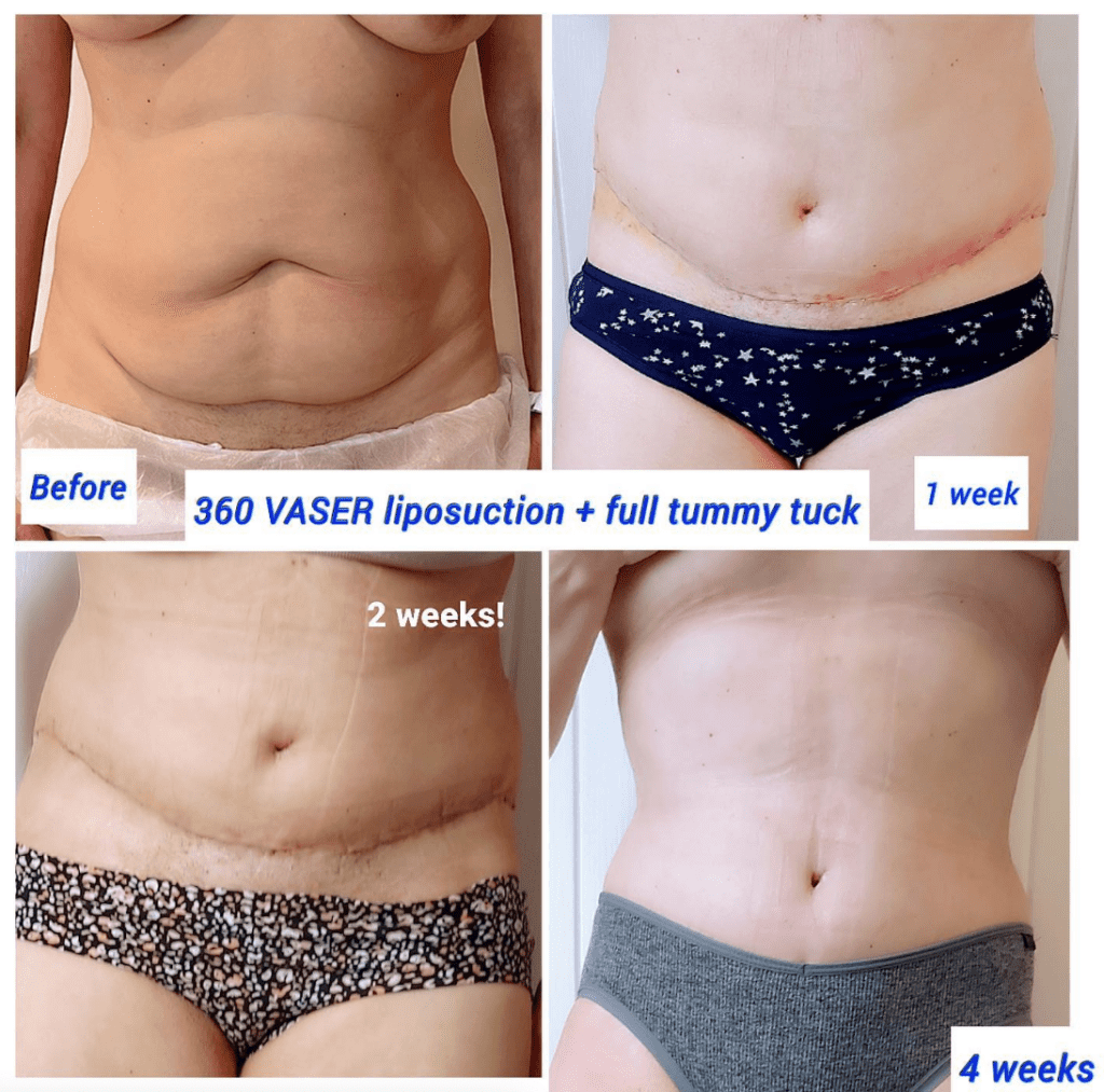 Areas for liposuction: Before and after Vaser liposuction and full tummy tuck