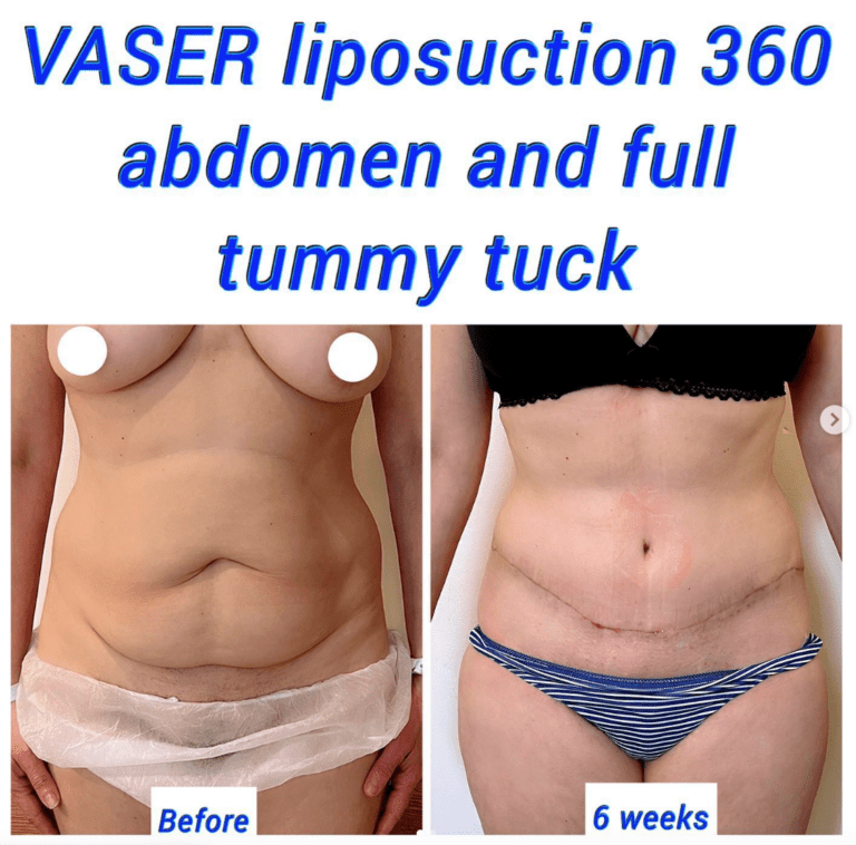 Vaser liposuction and full tummy tuck