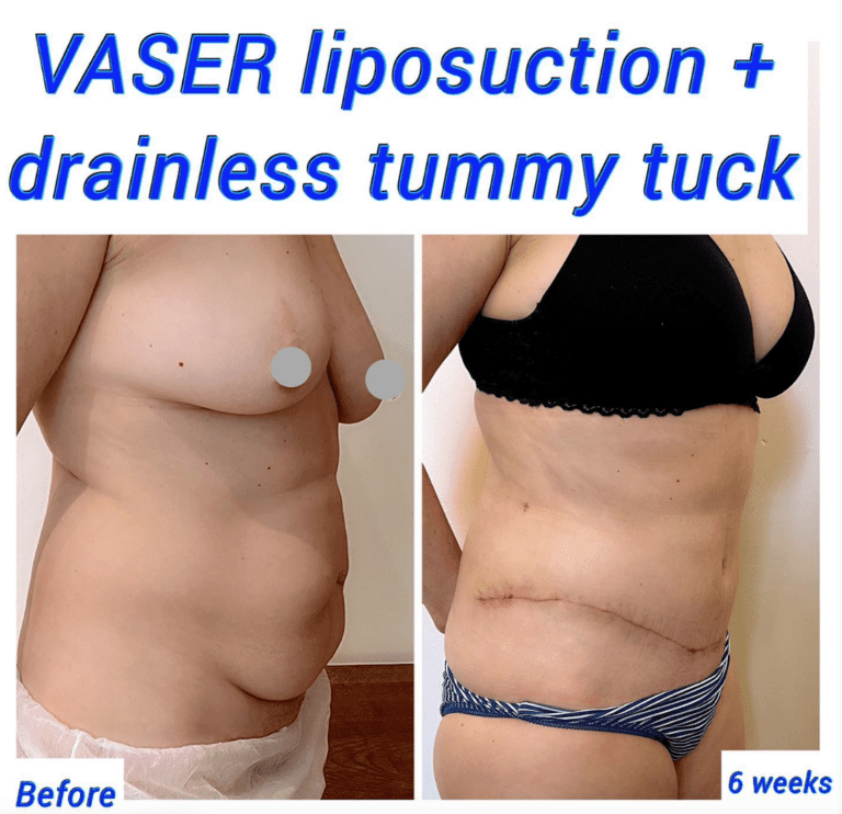 Vaser liposuction and full tummy tuck
