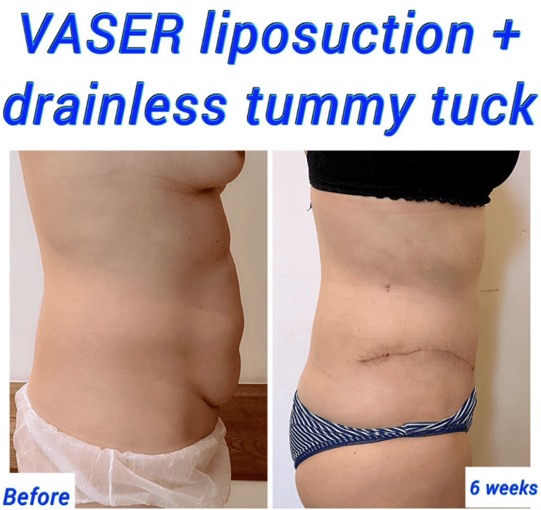 Vaser liposuction recovery and full tummy tuck