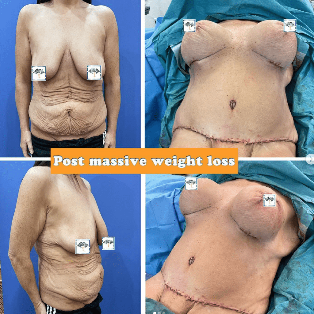 Tummy tuck post massive weight loss
