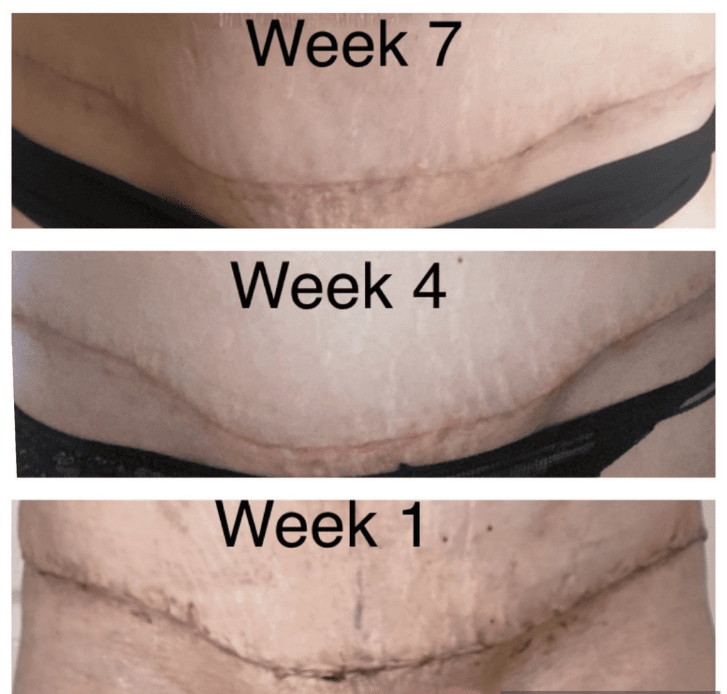 Cómo se desvanecen y refinan las cicatrices de la abdominoplastia - semana 1, semana 4, semana 7 - Harley Clinic London