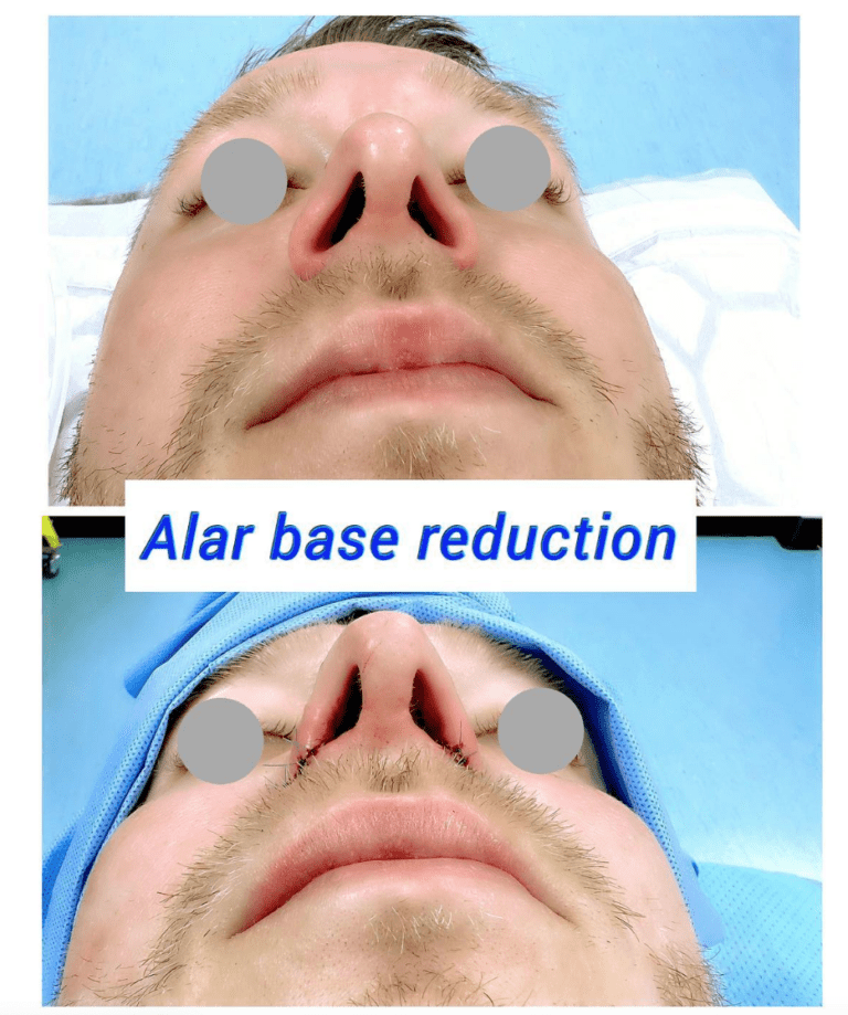 Before and after Alar base reduction