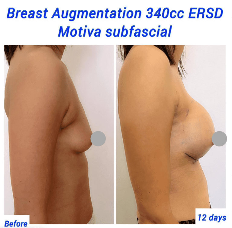 Before and after breast augmentation 340cc ERSD Motiva subfascial
