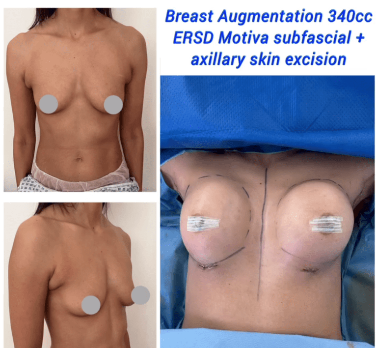 Breast augmentation 340cc ERSD Motiva subfasical + axillary skin excision