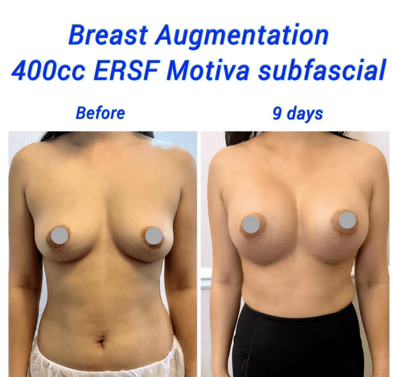 Breast augmentation 400cc ERSC Motiva