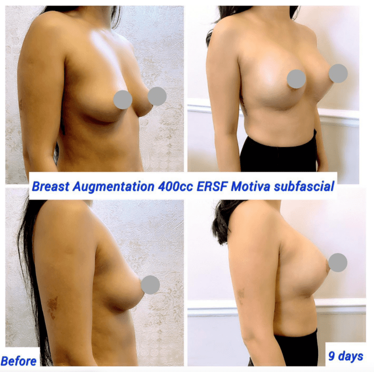 Before and after Breast augmentation 400cc ERSC Motiva