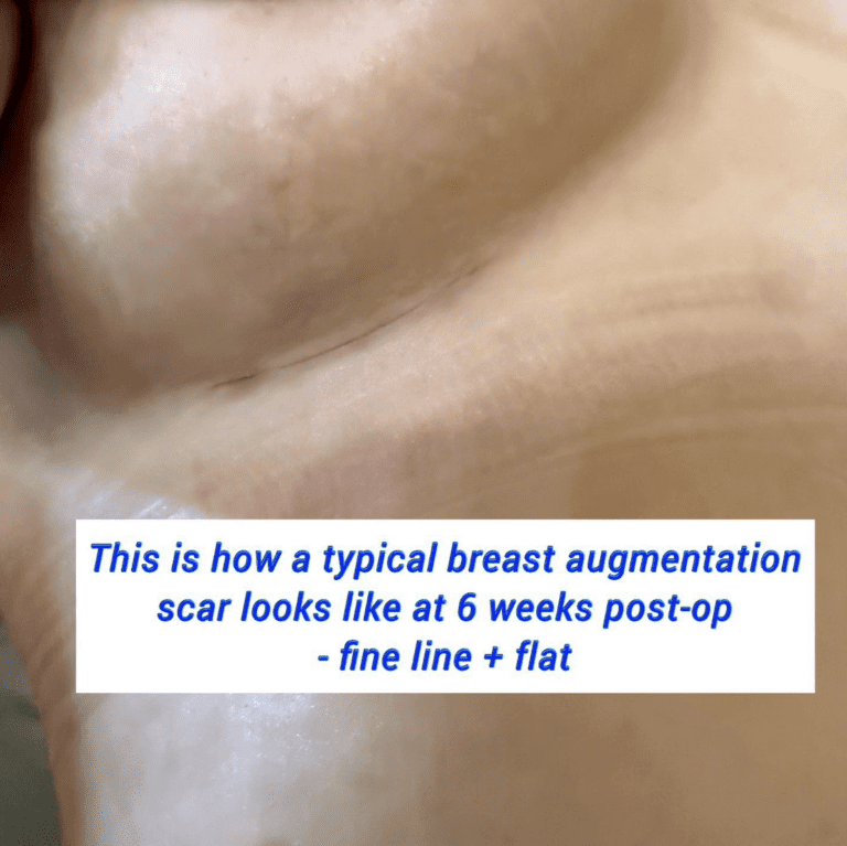 Typical breast augmentation scar 6 weeks post op - fine line and flat